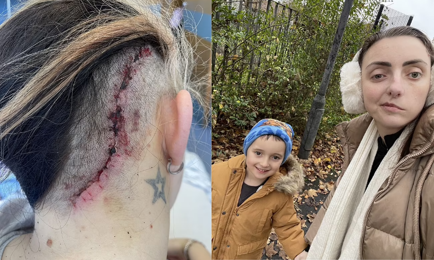 Tumor Cerebral Mortal Deixa Mulher com o Rosto Desfigurado Após Olho Trêmulo Revelar a Condição